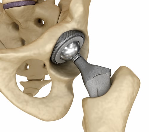 Selecting Metals And Alloys For Medical Device Manufacturing Balaji